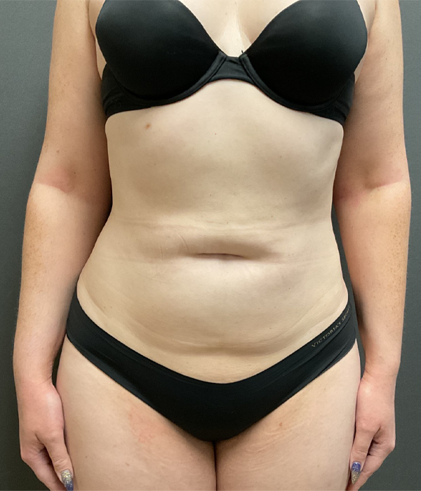 Tummy Tuck