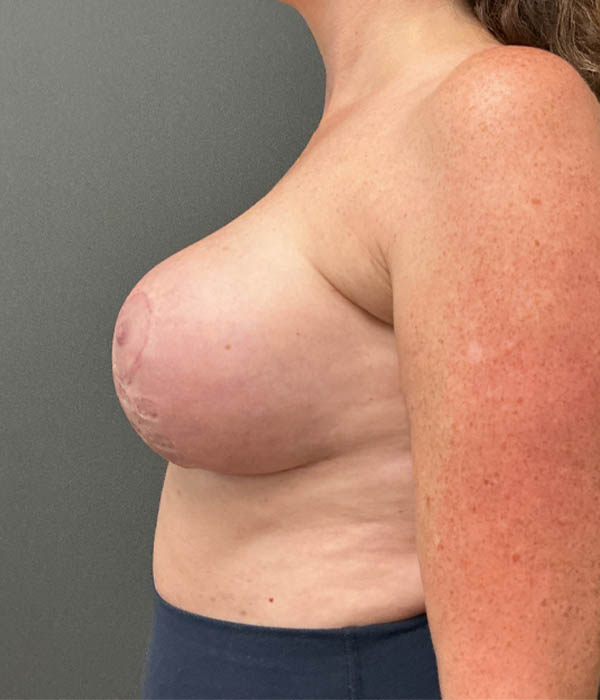 Breast Lift