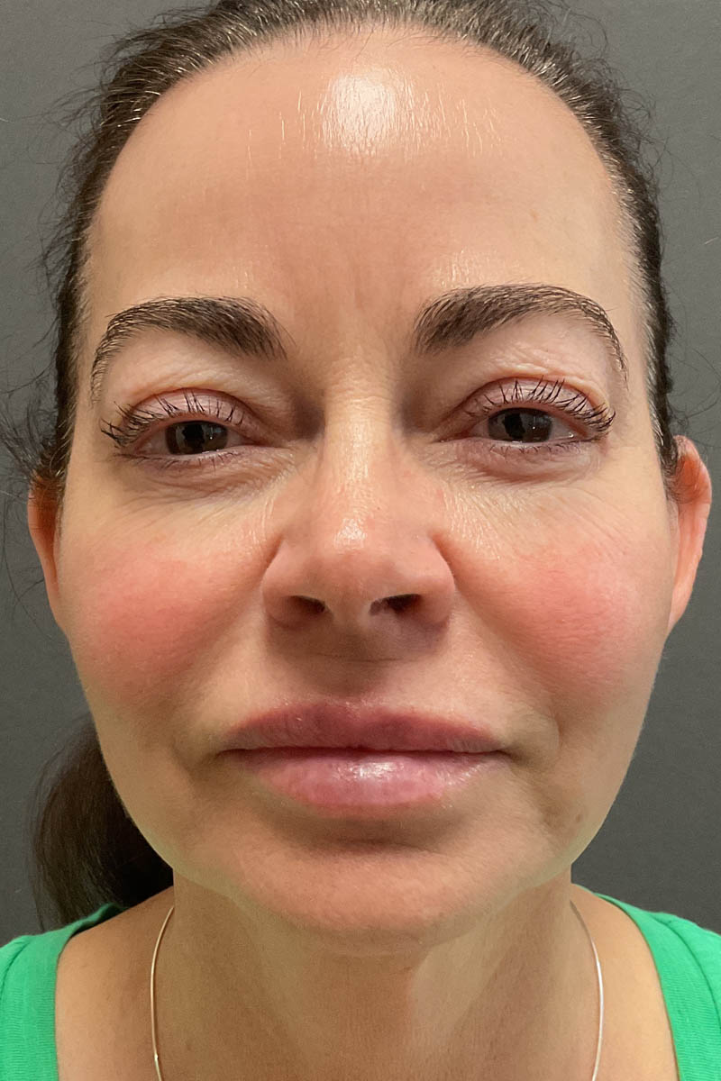 Facelift