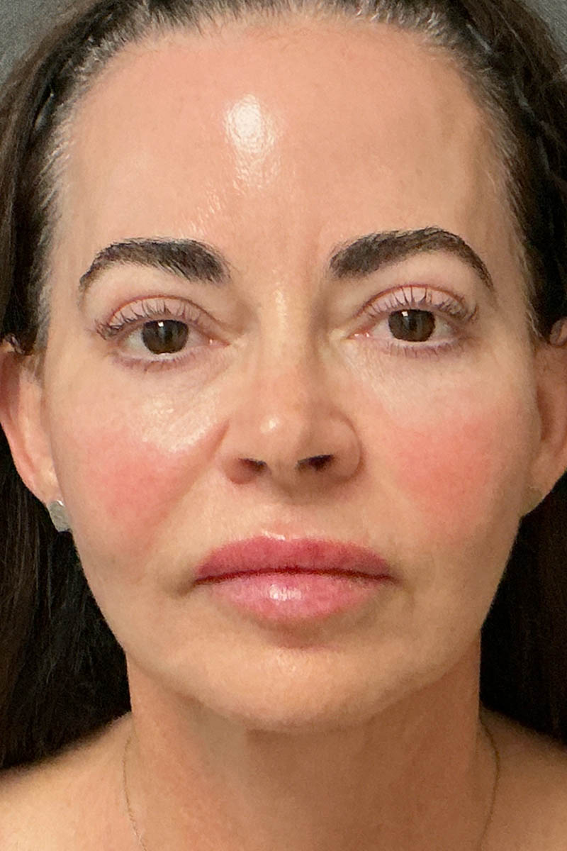 Facelift