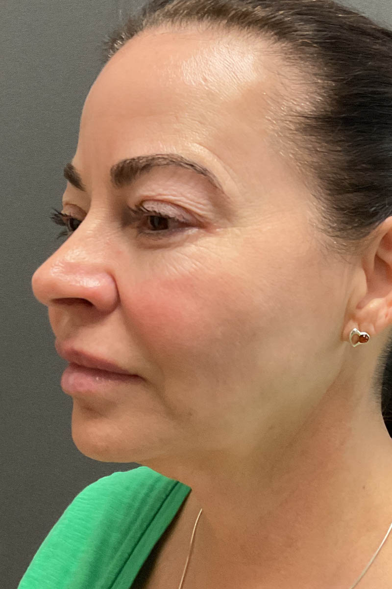 Facelift
