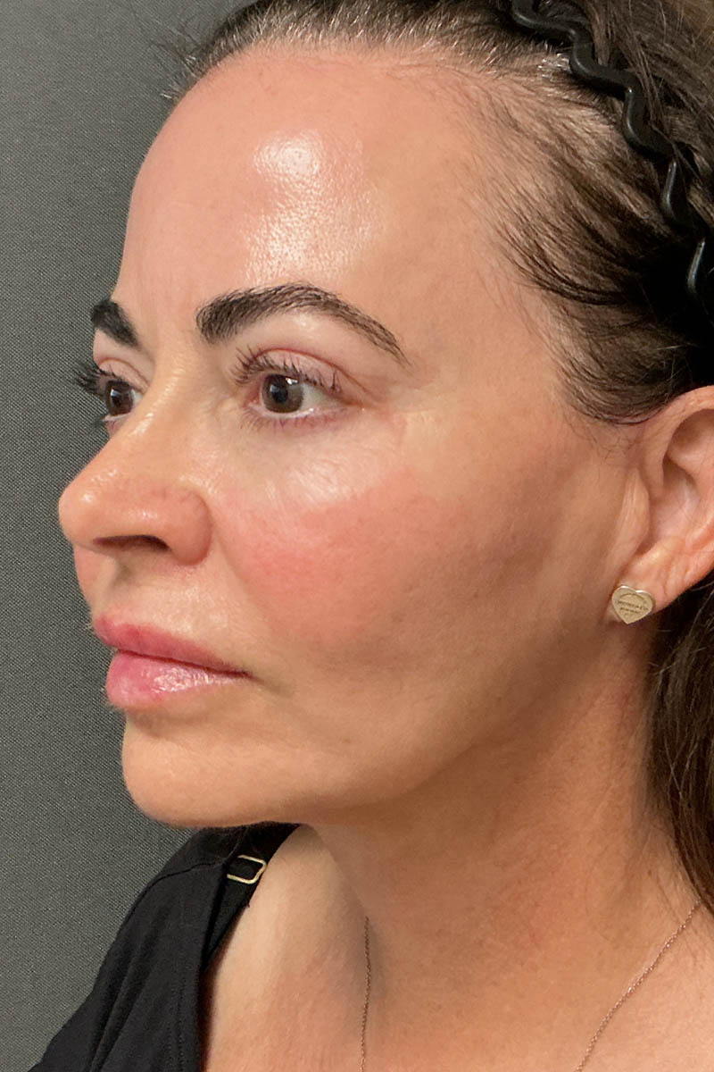 Facelift