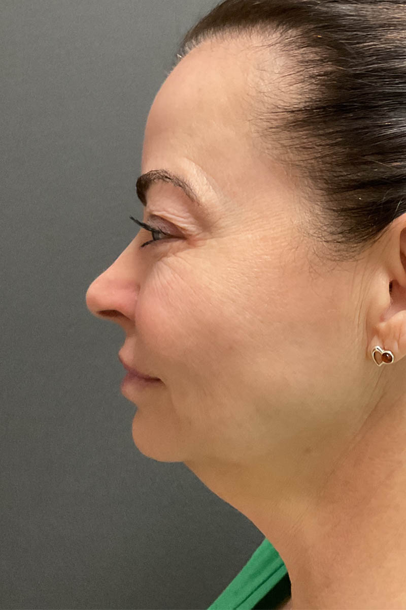 Facelift