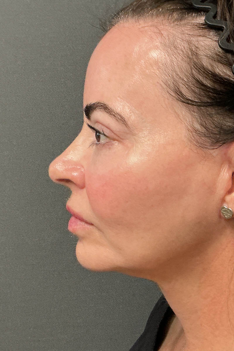 Facelift