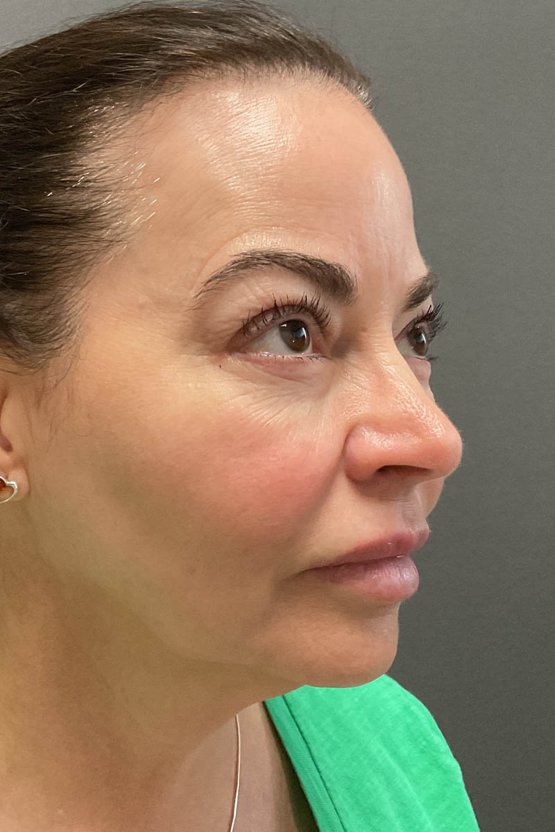 Facelift
