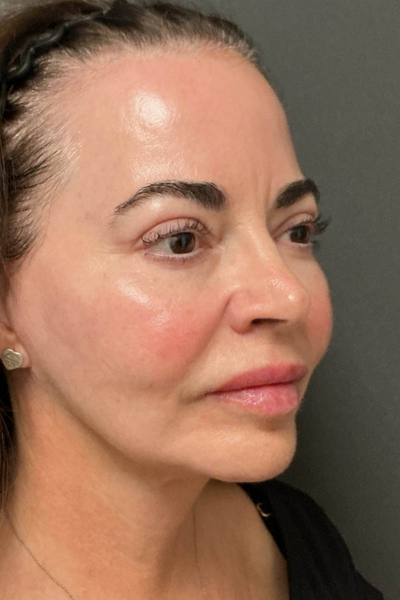 Facelift