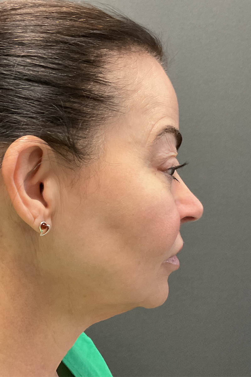 Facelift