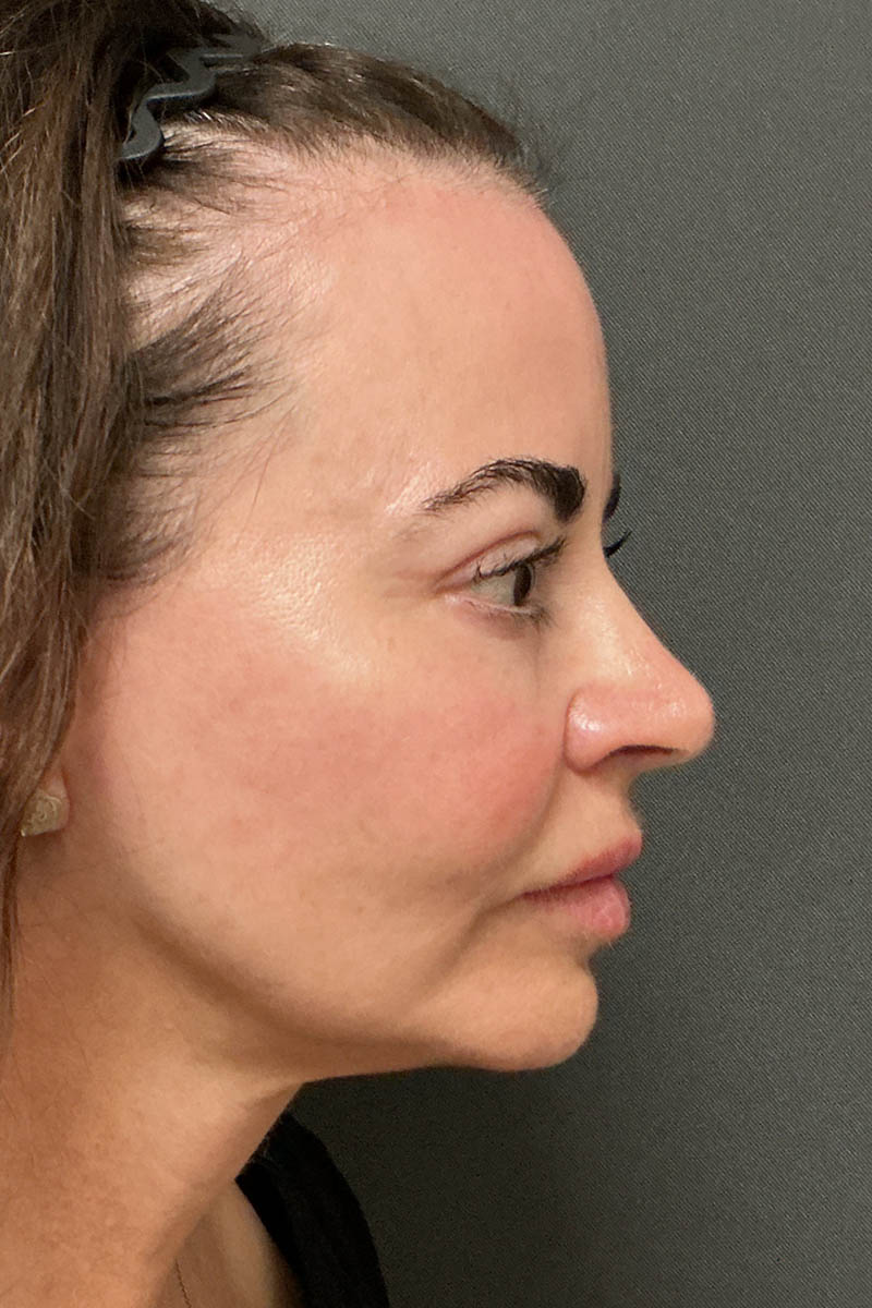 Facelift