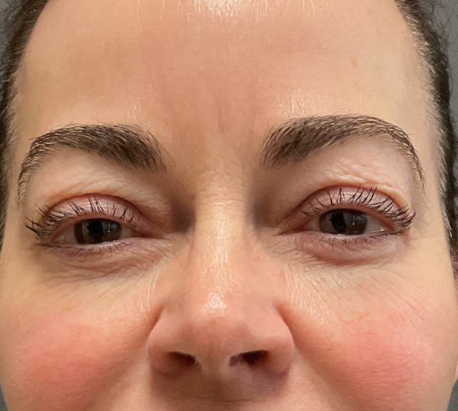 Blepharoplasty