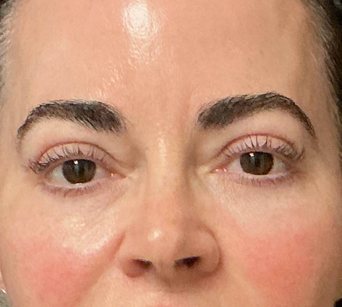 Blepharoplasty