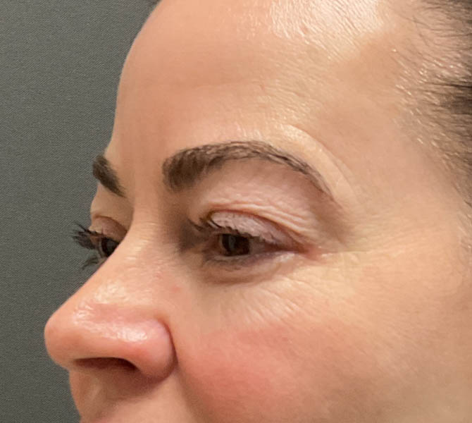 Blepharoplasty