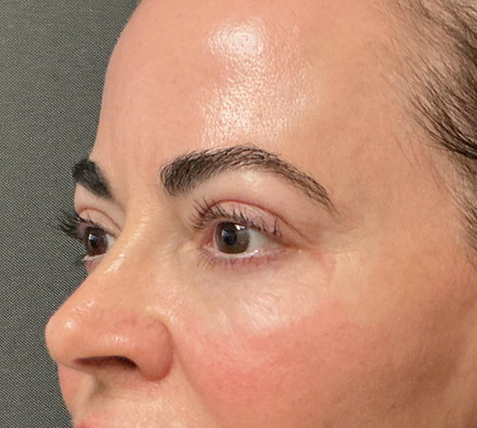 Blepharoplasty