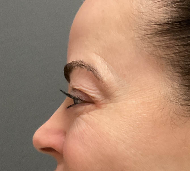Blepharoplasty