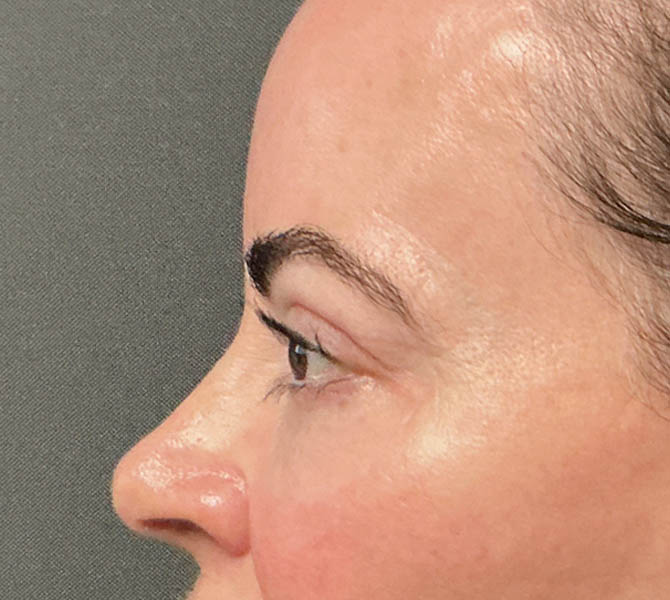 Blepharoplasty
