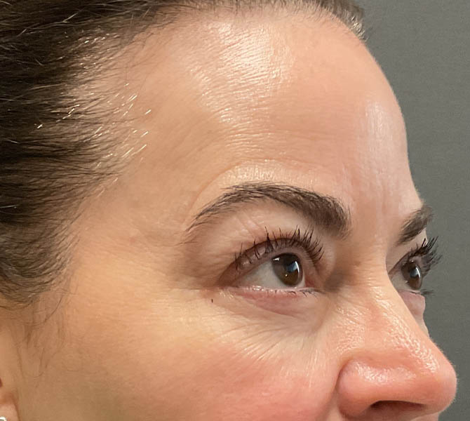 Blepharoplasty