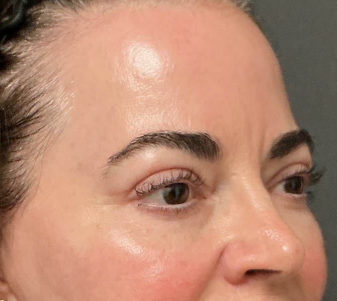 Blepharoplasty