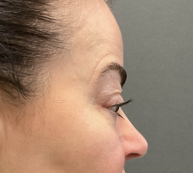 Blepharoplasty