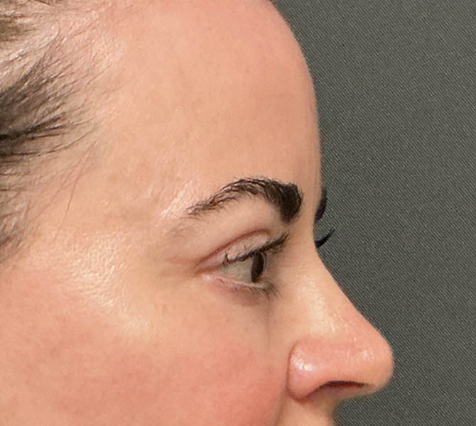 Blepharoplasty